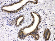 IHC testing of FFPE human breast cancer tissue with GAD65 antibody at 1ug/ml. Required HIER: steam section in pH6 citrate buffer for 20 min and allow to cool prior to testing.