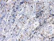 IHC testing of FFPE human lung cancer tissue with Bax antibody at 1ug/ml. Required HIER: steam section in pH6 citrate buffer for 20 min and allow to cool prior to testing.