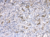 IHC testing of FFPE human intestinal cancer tissue with Bax antibody at 1ug/ml. Required HIER: steam section in pH6 citrate buffer for 20 min and allow to cool prior to testing.