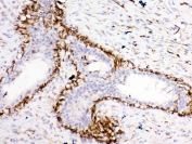 IHC testing of FFPE human breast cancer tissue with Bcl-XL antibody at 1ug/ml. Required HIER: steam section in pH6 citrate buffer for 20 min and allow to cool prior to testing.