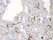 IHC testing of FFPE human lung cancer tissue with Bcl-XL antibody at 1ug/ml. Required HIER: steam section in pH6 citrate buffer for 20 min and allow to cool prior to testing.