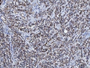IHC staining of FFPE human breast cancer tissue with CD166 antibody. HIER: boil tissue sections in pH8 EDTA for 20 min and allow to cool before testing.