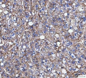 IHC staining of FFPE human liver cancer tissue with CD166 antibody. HIER: boil tissue sections in pH8 EDTA for 20 min and allow to cool before testing.