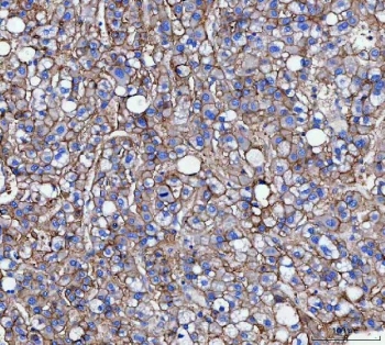 IHC staining of FFPE human liver cancer tissue with CD166 antibody. HIER: boil tissue sections in pH8 EDTA for 20 min and allow to cool before testing.