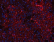 Immunofluorescent staining of FFPE human liver cancer tissue with CD166 antibody (red) and DAPI nuclear stain (blue). HIER: steam section in pH8 EDTA buffer for 20 min.