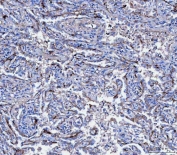 IHC staining of FFPE human lung cancer tissue with CD166 antibody. HIER: boil tissue sections in pH8 EDTA for 20 min and allow to cool before testing.