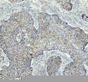 IHC testing of FFPE human lung cancer tissue with GAS6 antibody at 1ug/ml. Required HIER: steam section in pH8 EDTA buffer for 20 min and allow to cool prior to testing.