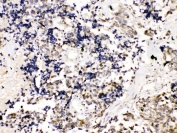IHC testing of FFPE human lung cancer tissue with TRF2 antibody at 1ug/ml. Required HIER: steam section in pH6 citrate buffer for 20 min and allow to cool prior to testing.