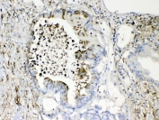 IHC testing of FFPE human intestinal cancer tissue with TMEM107 antibody at 1ug/ml. Required HIER: steam section in pH6 citrate buffer for 20 min and allow to cool prior to testing.