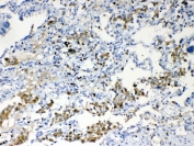 IHC testing of FFPE human lung cancer tissue with TMEM107 antibody at 1ug/ml. Required HIER: steam section in pH6 citrate buffer for 20 min and allow to cool prior to testing.