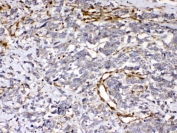 IHC testing of FFPE human lung cancer tissue with Cytoglobin antibody at 1ug/ml. Required HIER: steam section in pH6 citrate buffer for 20 min and allow to cool prior to testing.