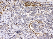 IHC testing of FFPE human lung cancer tissue with Cytoglobin antibody at 1ug/ml. Required HIER: steam section in pH6 citrate buffer for 20 min and allow to cool prior to testing.