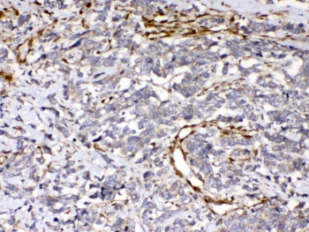 IHC testing of FFPE human lung cancer tissue with Cytoglobin antibody at 1ug/ml. Required HIER: steam section in pH6 citrate buffer for 20 min and allow to cool prior to testing.