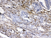 IHC testing of FFPE human intestinal cancer tissue with Cytoglobin antibody at 1ug/ml. Required HIER: steam section in pH6 citrate buffer for 20 min and allow to cool prior to testing.