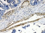 IHC testing of FFPE human intestinal cancer tissue with CPI-17 antibody at 1ug/ml. Required HIER: steam section in pH6 citrate buffer for 20 min and allow to cool prior to testing.