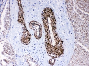 IHC testing of FFPE human lung cancer tissue with CPI-17 antibody at 1ug/ml. Required HIER: steam section in pH6 citrate buffer for 20 min and allow to cool prior to testing.