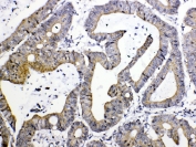 IHC testing of FFPE human intestinal cancer tissue with TIMP4 antibody at 1ug/ml. Required HIER: steam section in pH6 citrate buffer for 20 min and allow to cool prior to testing.