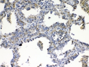 IHC testing of FFPE human lung cancer tissue with TIMP4 antibody at 1ug/ml. Required HIER: steam section in pH6 citrate buffer for 20 min and allow to cool prior to testing.