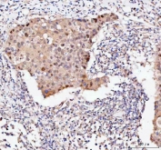IHC staining of FFPE human breast cancer tissue with BAG1 antibody. HIER: boil tissue sections in pH8 EDTA for 20 min and allow to cool before testing.