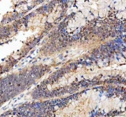 IHC staining of FFPE human colorectal adenocarcinoma tissue with BAG1 antibody. HIER: boil tissue sections in pH8 EDTA for 20 min and allow to cool before testing.