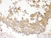 IHC testing of FFPE human breast cancer tissue with NDRG3 antibody at 1ug/ml. Required HIER: steam section in pH6 citrate buffer for 20 min and allow to cool prior to testing.