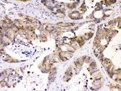 IHC testing of FFPE human intestinal cancer tissue with NDRG3 antibody at 1ug/ml. Required HIER: steam section in pH6 citrate buffer for 20 min and allow to cool prior to testing.