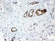 IHC testing of FFPE human breast cancer tissue with HSP22 antibody at 1ug/ml. Required HIER: steam section in pH6 citrate buffer for 20 min and allow to cool prior to testing.