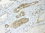 IHC testing of FFPE human lung cancer tissue with HSP22 antibody at 1ug/ml. Required HIER: steam section in pH6 citrate buffer for 20 min and allow to cool prior to testing.