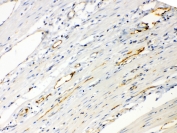 IHC testing of FFPE human intestinal cancer tissue with ANGPTL2 antibody at 1ug/ml. Required HIER: steam section in pH6 citrate buffer for 20 min and allow to cool prior to testing.