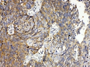IHC testing of FFPE human lung cancer tissue with RANK antibody at 1ug/ml. Required HIER: steam section in pH6 citrate buffer for 20 min and allow to cool prior to testing.