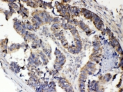 IHC testing of FFPE human intestinal cancer tissue with RANK antibody at 1ug/ml. Required HIER: steam section in pH6 citrate buffer for 20 min and allow to cool prior to testing.