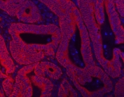 Immunofluorescent staining of FFPE human intestine cancer tissue with Beta Catenin antibody (red) and DAPI nuclear stain (blue). HIER: boil tissue sections in pH8 EDTA for 20 min and allow to cool before testing.