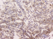 IHC testing of FFPE human liver cancer tissue with Beta Catenin antibody at 1ug/ml. Required HIER: steam section in pH6 citrate buffer for 20 min and allow to cool prior to testing.