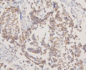 IHC staining of FFPE human glioma with EGFR antibody. HIER: boil tissue sections in pH6, 10mM citrate buffer, for 20 min and allow to cool before testing.