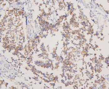 IHC staining of FFPE human glioma with EGFR antibody. HIER: boil tissue sections in pH6, 10mM citrate buffer, for 20 min and allow to cool before testing.