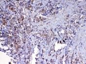 IHC testing of FFPE human lung cancer tissue with MAVS antibody at 1ug/ml. Required HIER: steam section in pH6 citrate buffer for 20 min and allow to cool prior to testing.