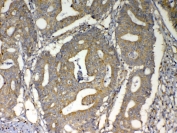 IHC testing of FFPE human intestinal cancer tissue with MAVS antibody at 1ug/ml. Required HIER: steam section in pH6 citrate buffer for 20 min and allow to cool prior to testing.