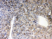 IHC testing of FFPE human liver cancer tissue with MAVS antibody at 1ug/ml. Required HIER: steam section in pH6 citrate buffer for 20 min and allow to cool prior to testing.