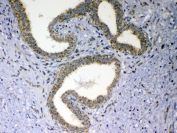 IHC testing of FFPE human breast cancer tissue with MAVS antibody at 1ug/ml. Required HIER: steam section in pH6 citrate buffer for 20 min and allow to cool prior to testing.