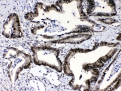 IHC testing of FFPE human intestinal cancer tissue with RAN antibody at 1ug/ml. Required HIER: steam section in pH6 citrate buffer for 20 min and allow to cool prior to testing.