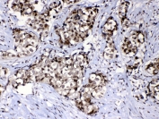 IHC testing of FFPE human breast cancer tissue with RAN antibody at 1ug/ml. Required HIER: steam section in pH6 citrate buffer for 20 min and allow to cool prior to testing.