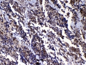 IHC testing of FFPE human lung cancer tissue with RAN antibody at 1ug/ml. Required HIER: steam section in pH6 citrate buffer for 20 min and allow to cool prior to testing.