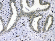 IHC testing of FFPE human breast cancer tissue with Cdc20 antibody at 1ug/ml. Required HIER: steam section in pH6 citrate buffer for 20 min and allow to cool prior to testing.