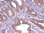 IHC testing of FFPE human colon cancer tissue with Cdc20 antibody at 1ug/ml. Required HIER: steam section in pH6 citrate buffer for 20 min and allow to cool prior to testing.