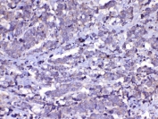 IHC testing of FFPE human lung cancer tissue with Cdc20 antibody at 1ug/ml. Required HIER: steam section in pH6 citrate buffer for 20 min and allow to cool prior to testing.