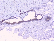 IHC staining of FFPE human breast cancer with PTP1B antibody. HIER: boil tissue sections in pH6, 10mM citrate buffer, for 20 min and allow to cool before testing.