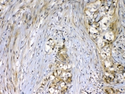 IHC testing of FFPE human breast cancer tissue with VEGFR2 antibody at 1ug/ml. Required HIER: steam section in pH6 citrate buffer for 20 min and allow to cool prior to testing.