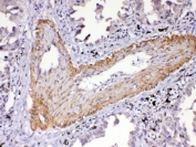 IHC testing of FFPE human lung cancer tissue with VEGFR2 antibody at 1ug/ml. Required HIER: steam section in pH6 citrate buffer for 20 min and allow to cool prior to testing.