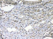 IHC testing of FFPE human intestinal cancer tissue with VEGFR2 antibody at 1ug/ml. Required HIER: steam section in pH6 citrate buffer for 20 min and allow to cool prior to testing.