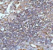 IHC staining of FFPE human rectum adenocarcinoma tissue with IL22 antibody. HIER: boil tissue sections in pH8 EDTA for 20 min and allow to cool before testing.